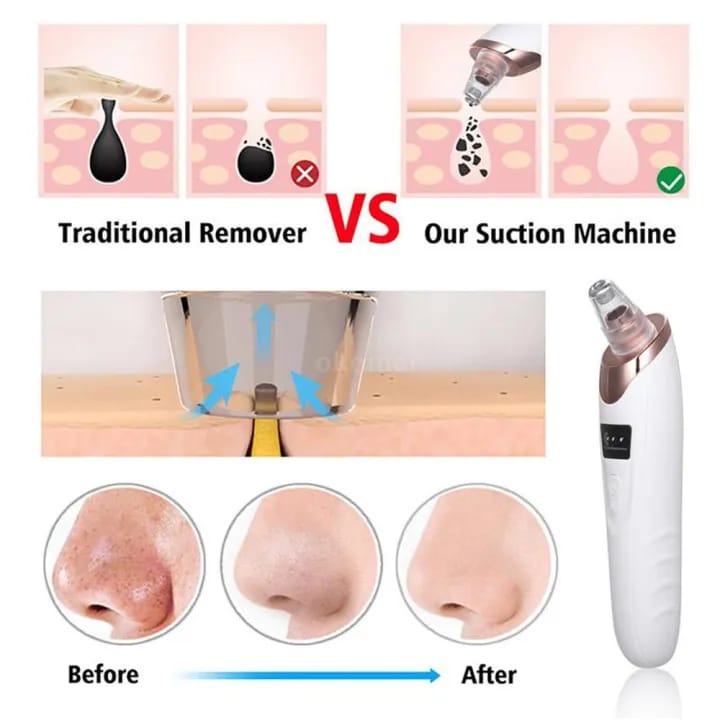 Blackhead Remover Vacuum